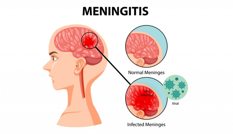 www.nusabali.com-cegah-meningitis-diimbau-jaga-pola-hidup-sehat