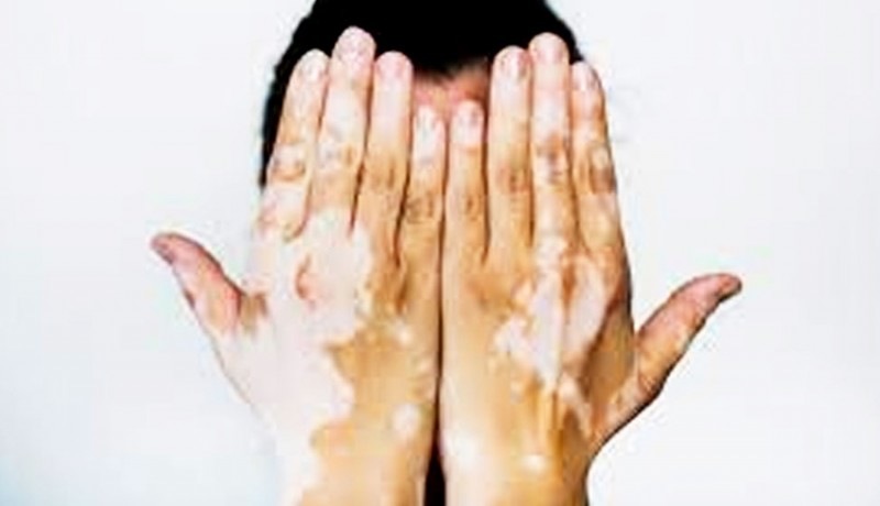 www.nusabali.com-bercak-putih-pada-tubuh-bisa-jadi-vitiligo
