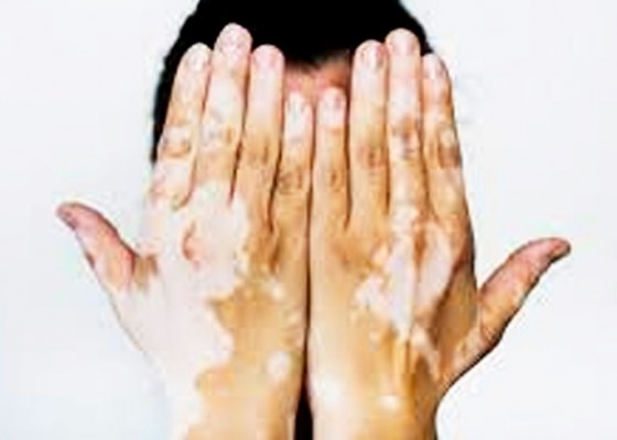 Nusabali.com - bercak-putih-pada-tubuh-bisa-jadi-vitiligo