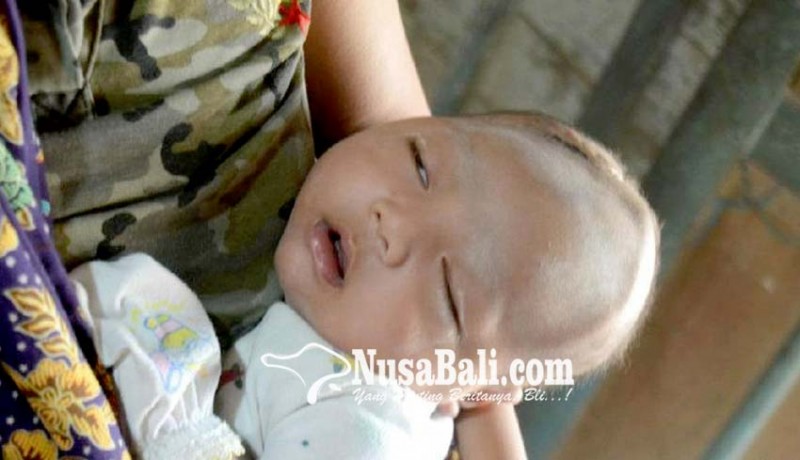 www.nusabali.com-bayi-di-rembang-alami-pendarahan-otak