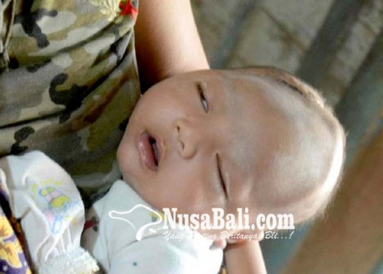 Nusabali.com - bayi-di-rembang-alami-pendarahan-otak