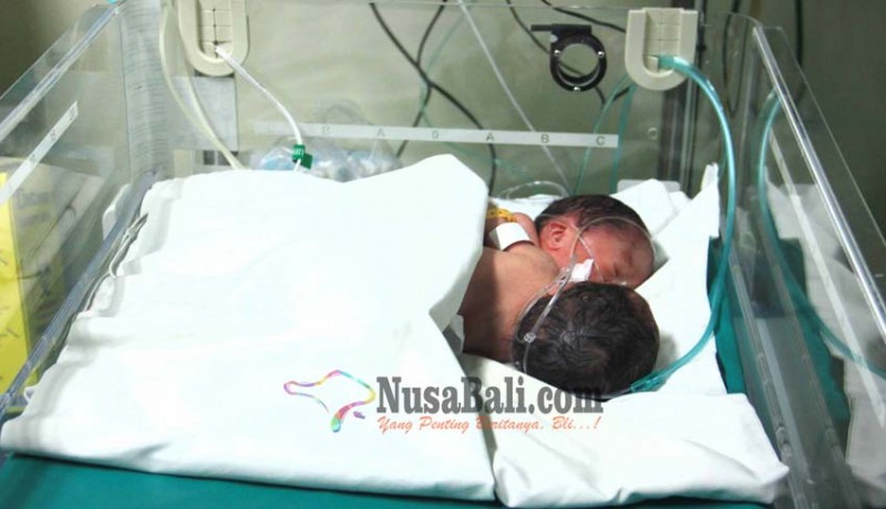 www.nusabali.com-bayi-kembar-siam-meninggal