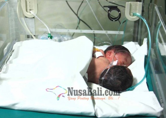 Nusabali.com - bayi-kembar-siam-meninggal