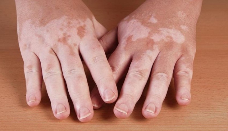 www.nusabali.com-mengenal-lebih-dekat-tentang-vitiligo