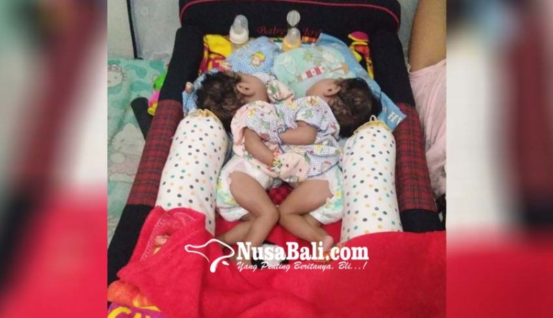 www.nusabali.com-bayi-kembar-siam-dari-seririt-akhirnya-meninggal
